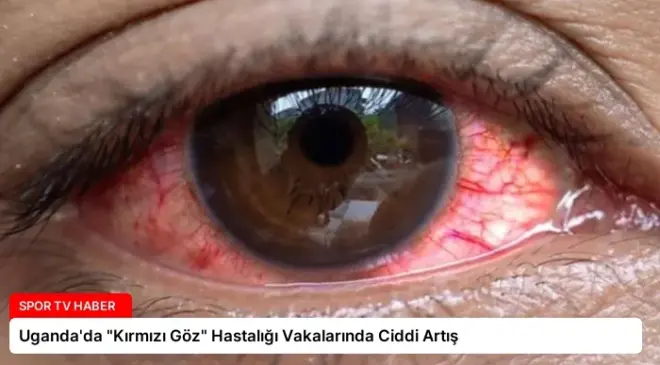 Uganda’da “Kırmızı Göz” Hastalığı Vakalarında Ciddi Artış